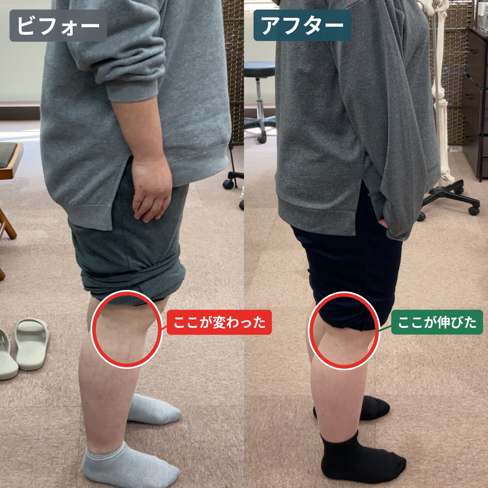 外側型変形性膝関節症の膝の伸展改善ビフォーアフター